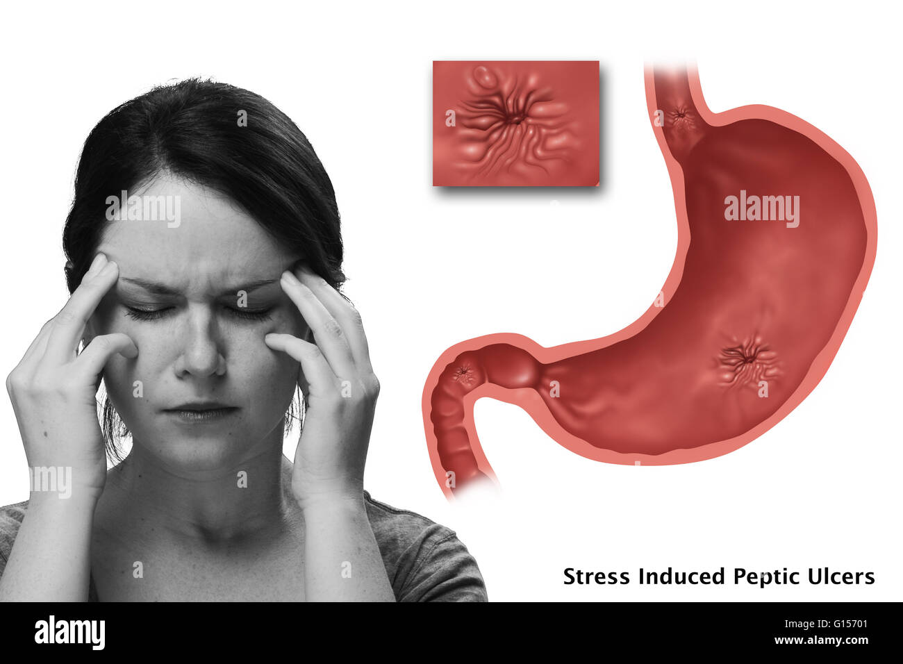 Immagine concettuale di stress indotto ulcere. Nella illustrata nello stomaco è presente un ulcera esofagea, una ulcera gastrica e un'ulcera duodenale presente. Foto Stock