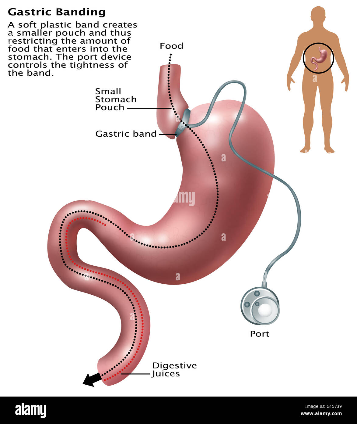 Illustrazione del bendaggio gastrico. Una chirurgia laparoscopica bendaggio gastrico regolabile, comunemente chiamato un lap-band, una banda o LAGB, è gonfiabile per un dispositivo di silicone posto attorno alla porzione superiore dello stomaco per il trattamento di obesità, destinati a rallentare il consumo di cibo e Foto Stock