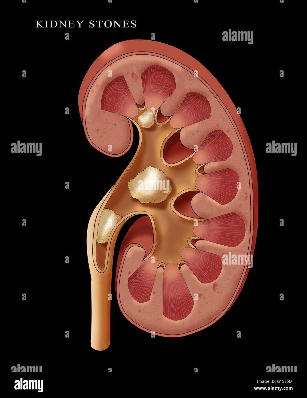 Illustrazione di una insufficienza renale pietra pelvico. I calcoli renali  sono formate quando sali minerali, la maggior parte spesso con la  partecipazione di calcio, si accumulano sulle superfici interne del rene.  Man