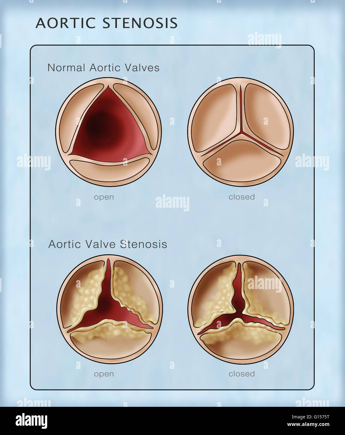 Illustrazione di un aperto e chiuso il normale della valvola aortica (sopra) rispetto a e di apertura e chiusura della valvola aortica stenosi (sotto). Foto Stock