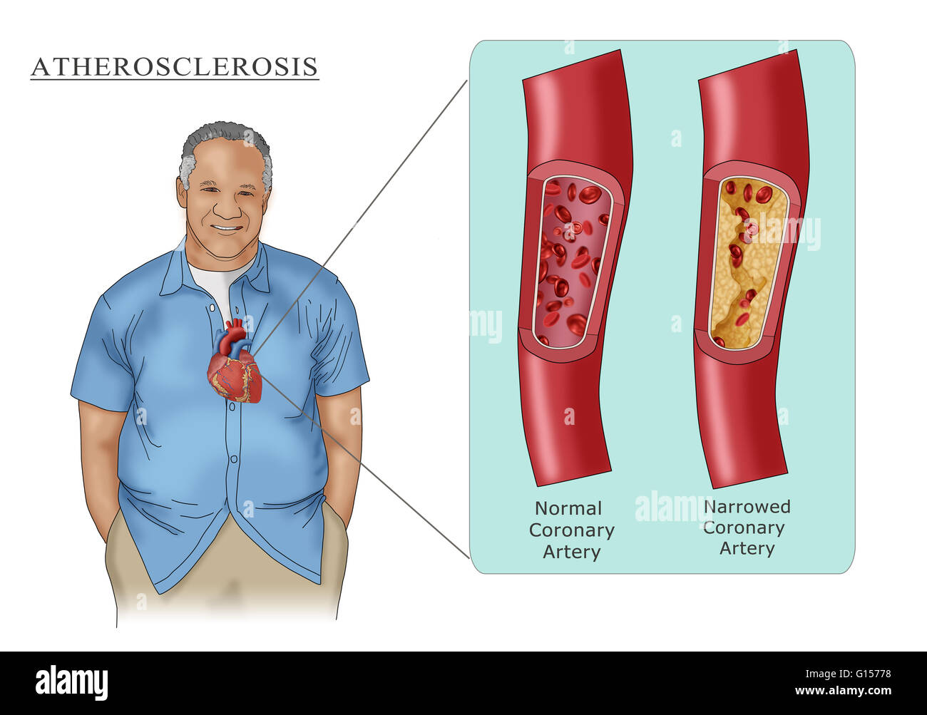 Illustrazione raffigurante un uomo con l'aterosclerosi, la limitazione del flusso di sangue attraverso l'arteria a causa di ostruzione della placca (riquadro destro). Per il confronto di una arteria normale è anche mostrato nel riquadro (sinistra). Foto Stock