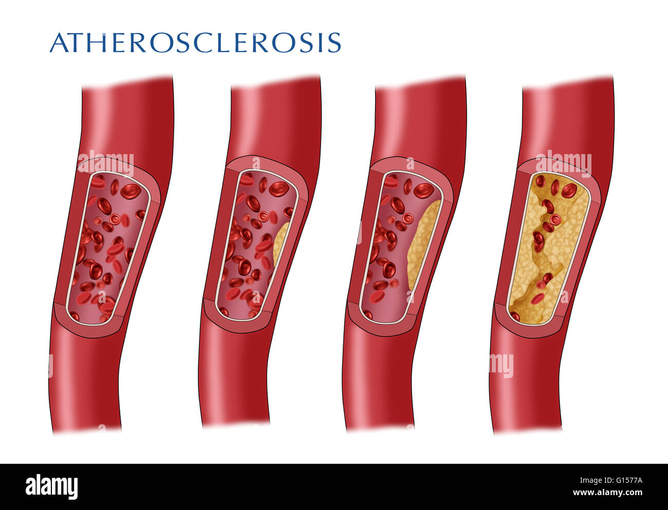 Illustrazione raffigurante la progressione di una arteria ristretta che conduce all'aterosclerosi. Un normale arteria con il normale flusso del sangue è rappresentato a sinistra lontana, l'arteria si sviluppa lentamente una placca di costruire che eventualmente limita il flusso sanguigno ampiamente (lontano Foto Stock