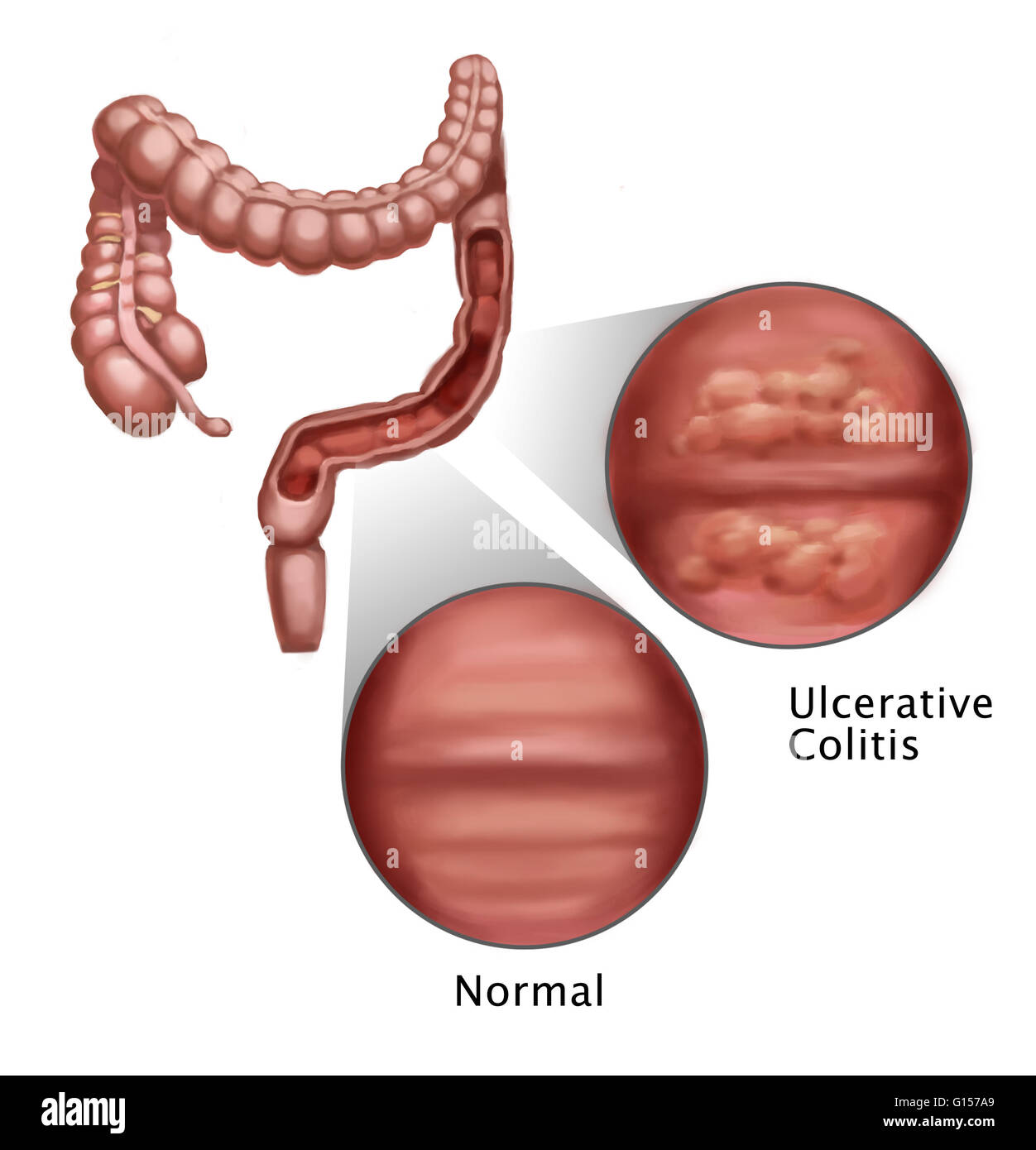 Illustrazione che mostra gli effetti di colite ulcerosa sulle pareti intestinali. La colite ulcerosa è una malattia infiammatoria intestinale che colpisce il rivestimento interno dell'intestino crasso. La malattia è caratterizzata dallo sviluppo di ulcere che iniziare a danneggiare t Foto Stock