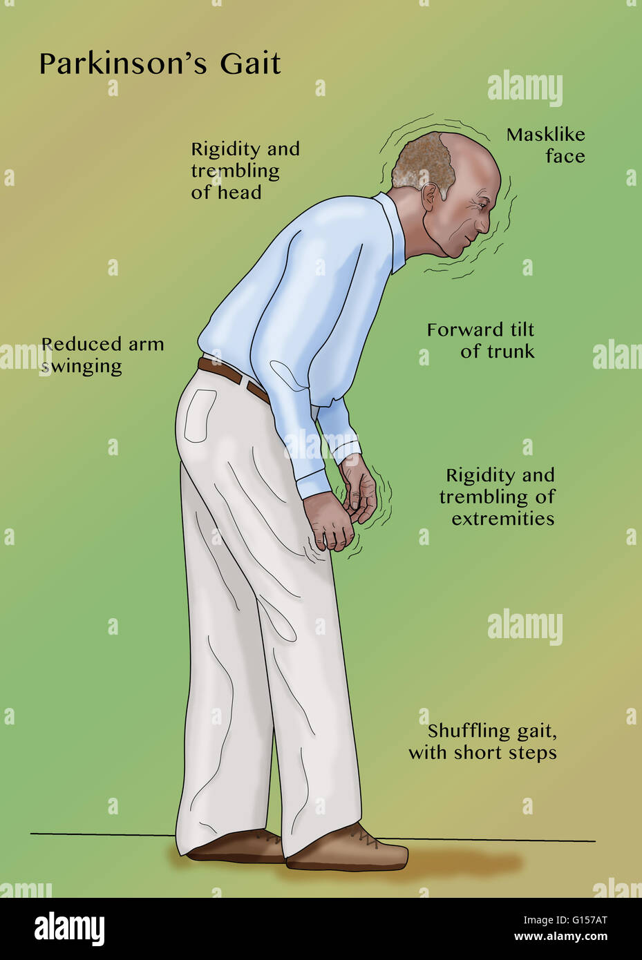 Illustrazione di un uomo con il morbo di Parkinson. Il morbo di Parkinson è un disturbo degenerativo del sistema nervoso centrale. Gli effetti che una persona di capacità motorie in anticipo, e più tardi nel pensiero di malattie e problemi comportamentali possono anche sorgere. I quattro principali mot Foto Stock
