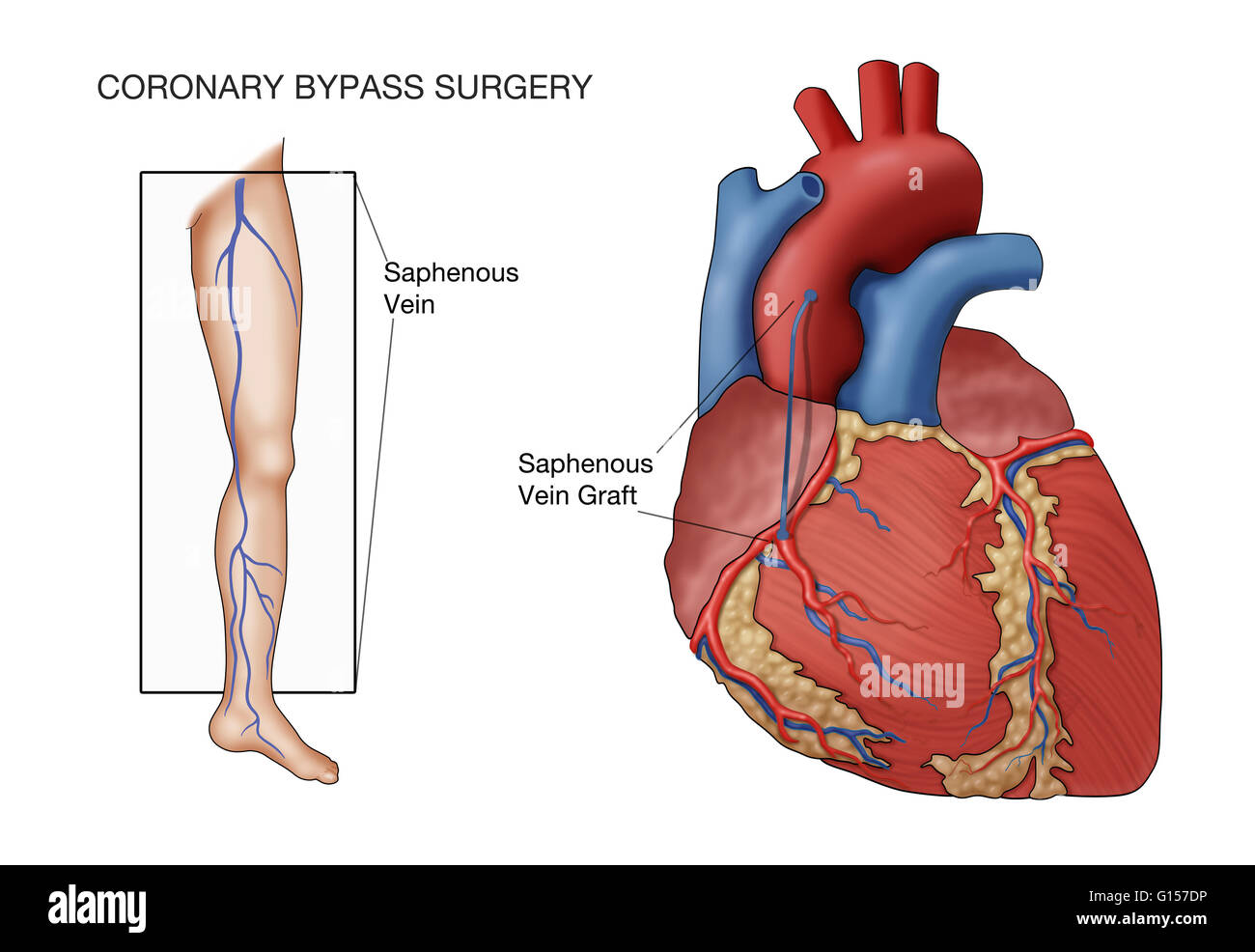La chirurgia dei bypass coronarici, denominata illustrazione. Una nave dal paziente la vena grande safena (in gamba) è innestato tra l'aorta e la coronaria ostruito, a valle dell'ostruzione, in modo da ripristinare il sangue di irrigazione del cuore. Foto Stock