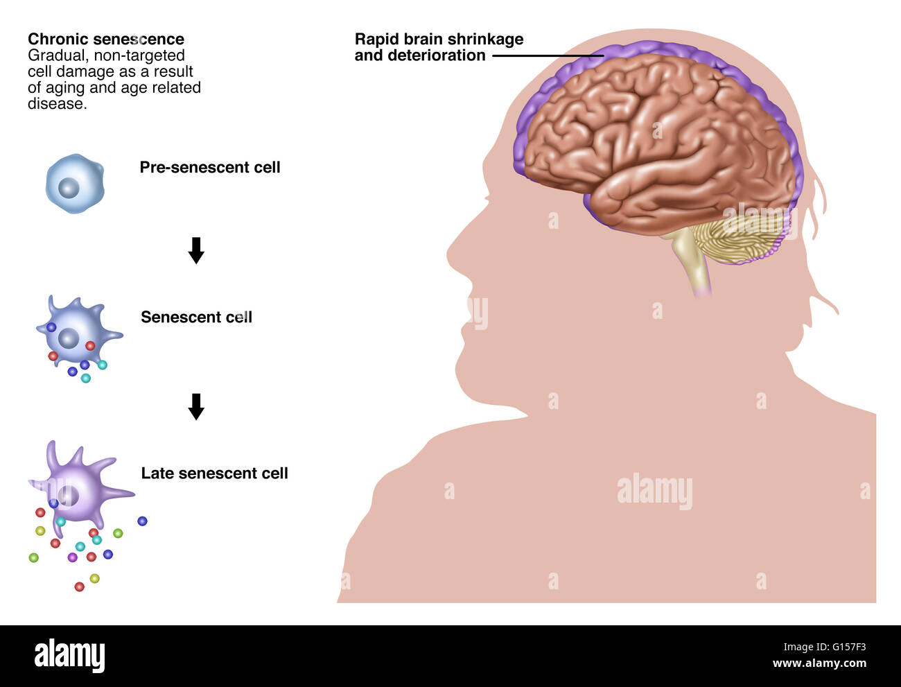 Illustrazione raffigurante cronica di senescenza graduale, non mirati a danno cellulare come un risultato di invecchiamento e di età di malattie correlate, eventualmente il morbo di Alzheimer. Cellule a sinistra che mostra un progressivo danneggiamento, dall'alto verso il basso: pre-cellula senescente, cellula senescente, fine senescente cell. Foto Stock