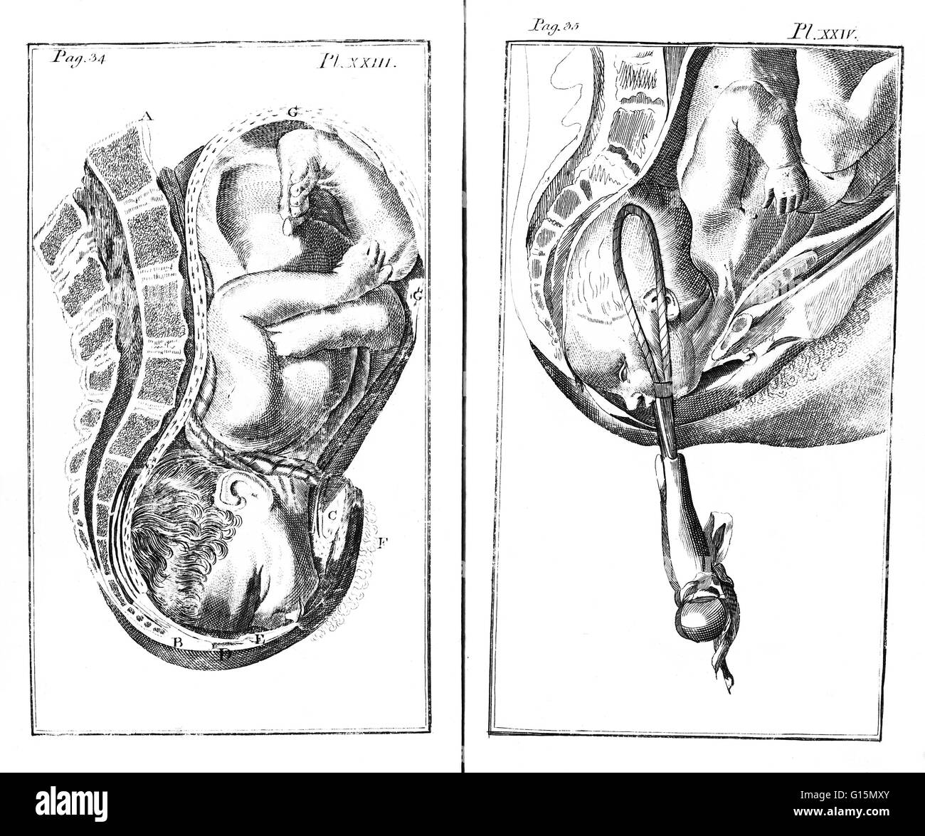 Due immagini del parto: piastra 23 (sinistra) mostra il bambino nel grembo con cordone ombelicale e la piastra 24 (a destra) mostra il forcipe essendo utilizzato per consegnare il bambino. Pinza sono uno strumento chirurgico che assomiglia a una coppia di pinze e può essere utilizzato in chirurgia per afferrare, uomo Foto Stock