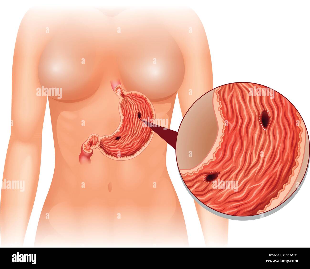 Ulcera di stomaco diagramma nella donna illustrazione Illustrazione Vettoriale