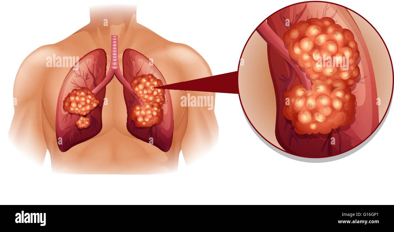 Il cancro del polmone schema di Dettagli immagine Illustrazione Vettoriale
