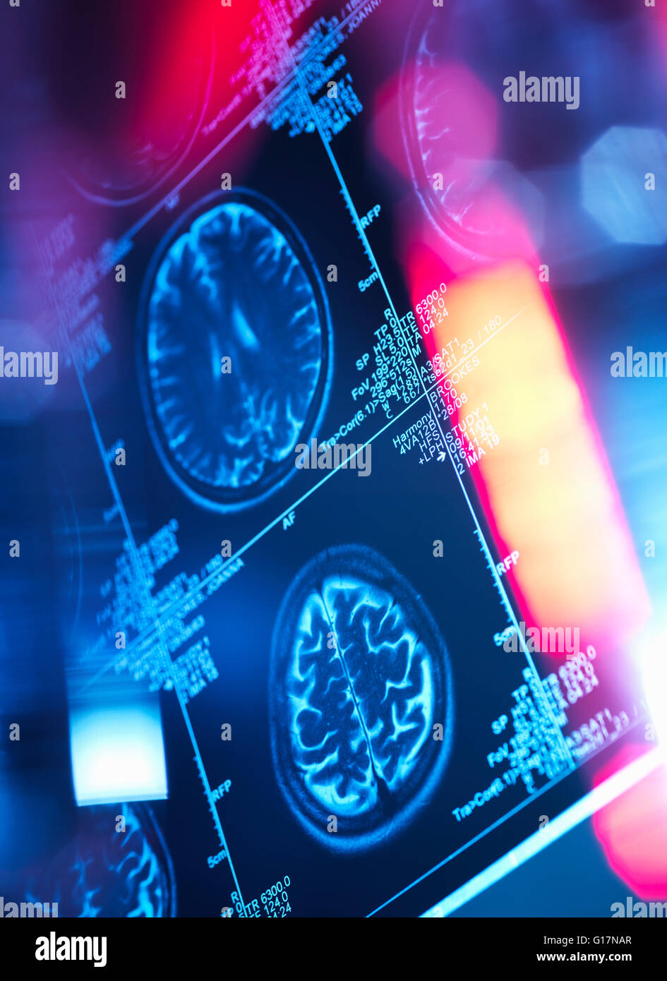 Cervello umano per eseguire la scansione in una clinica di neurologia Foto Stock