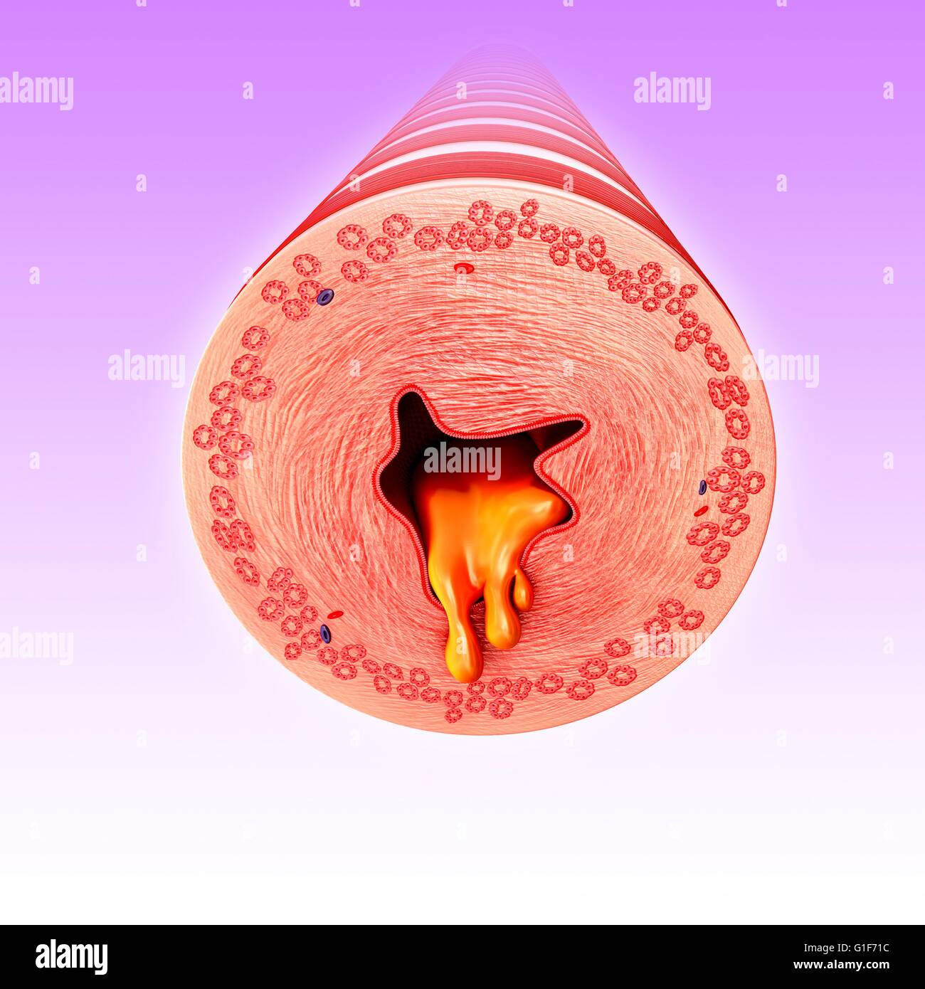 Bronco infetti del polmone umano, illustrazione. Foto Stock