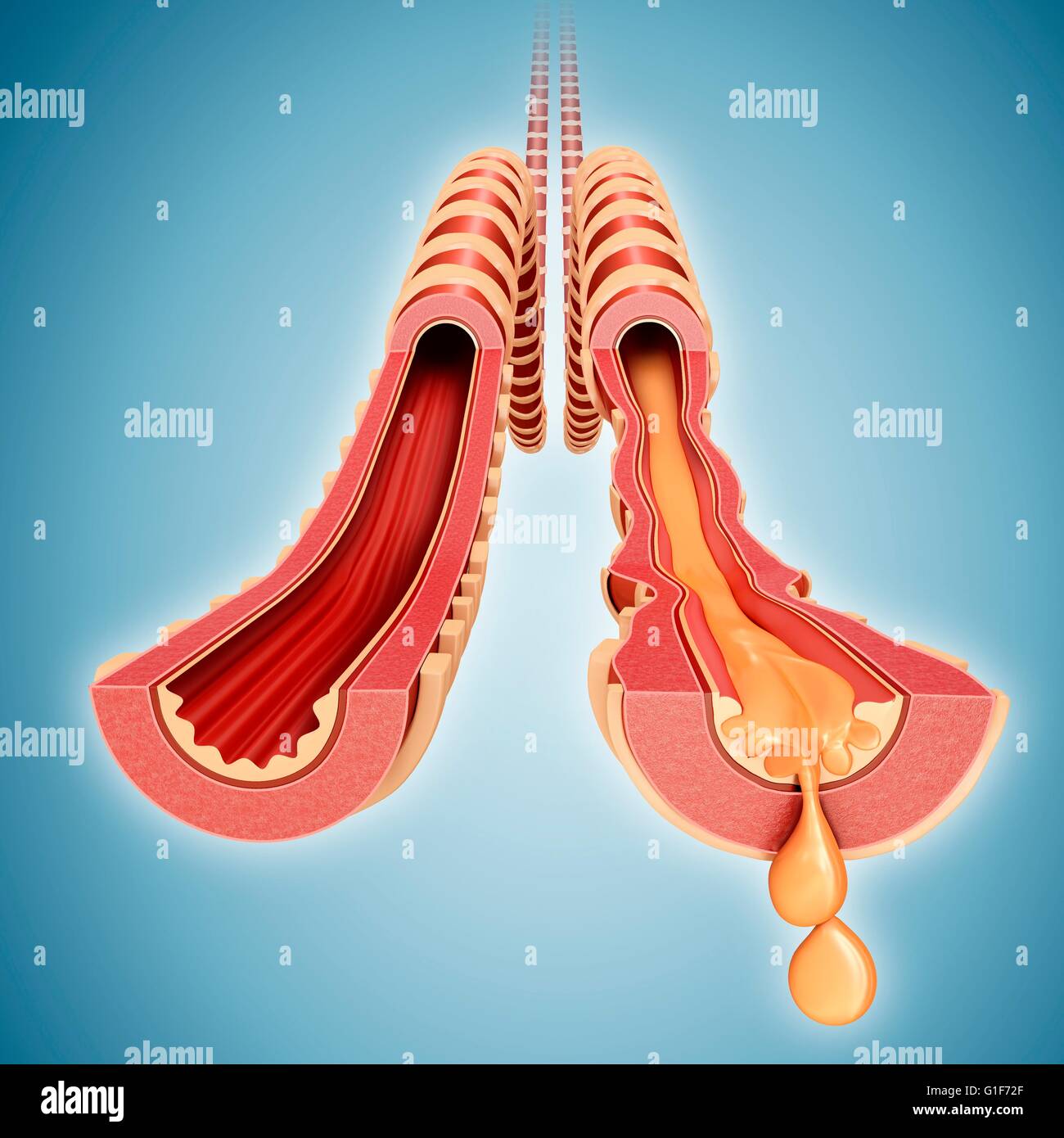Infetti bronco umano dei polmoni, illustrazione. Foto Stock
