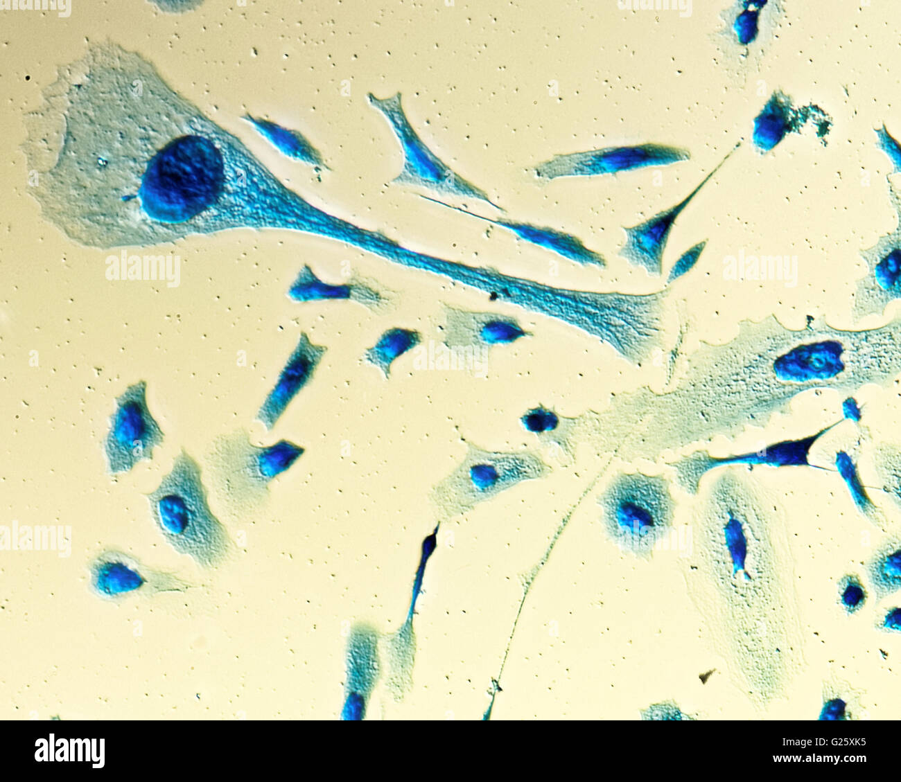 Umana PC-3 di cellule di cancro della prostata, colorati con blu Coomassie, sotto differencial interference contrast microscopio. Foto Stock