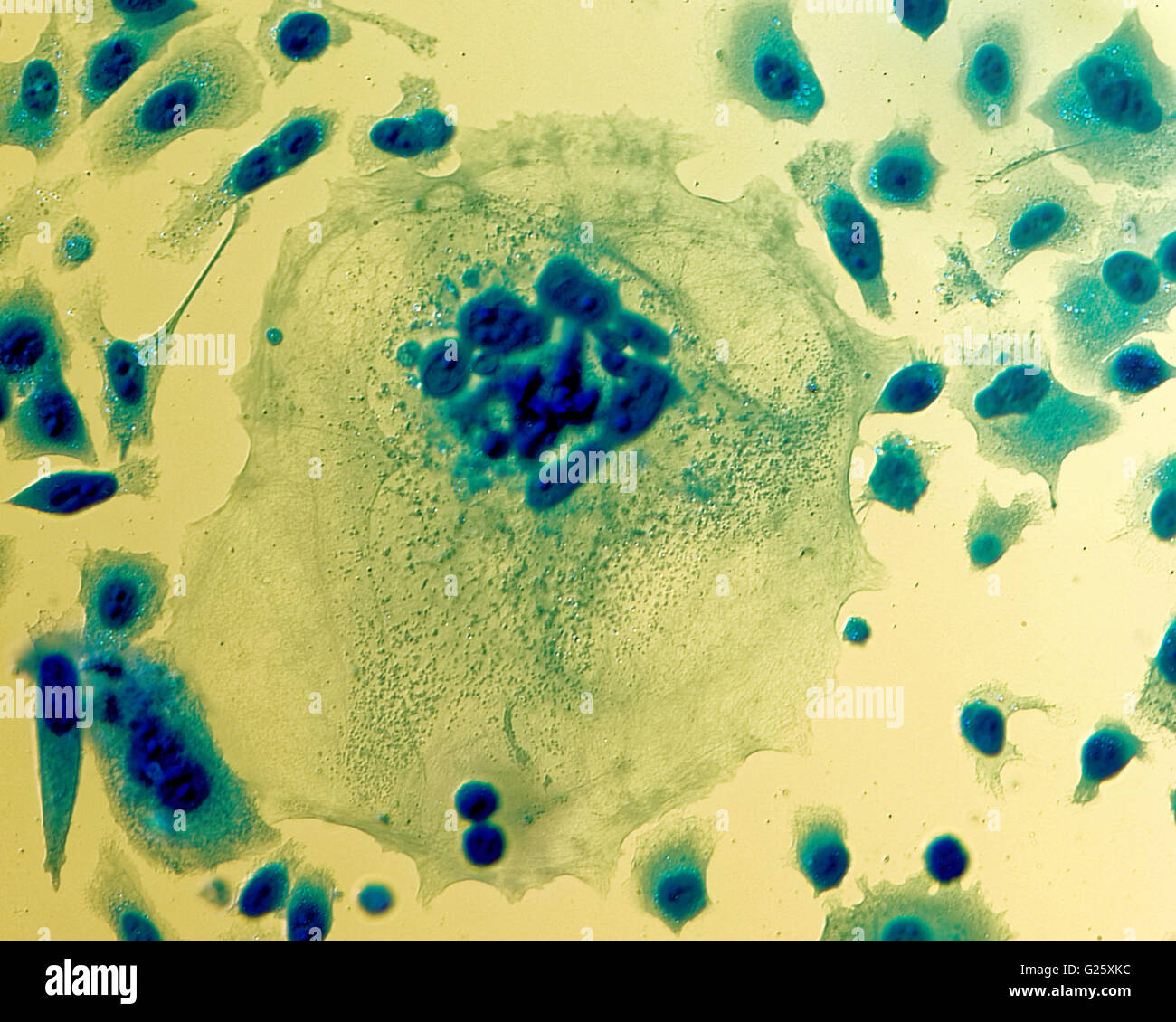 Umana PC-3 di cellule di cancro della prostata, colorati con blu Coomassie, sotto differencial interference contrast microscopio. Foto Stock