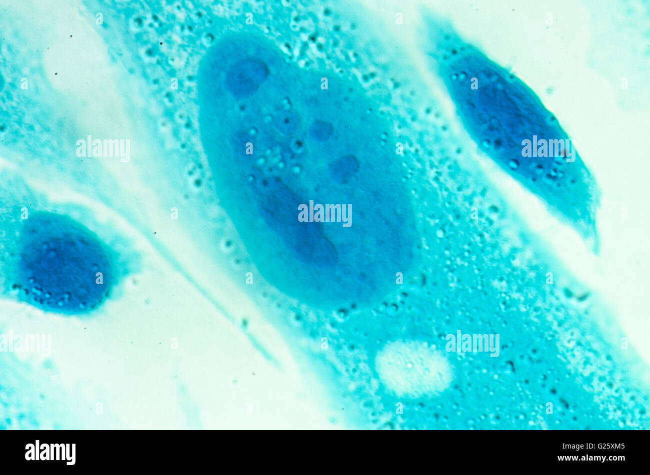 Umana PC-3 di cellule di cancro della prostata, colorati con blu Coomassie, sotto differencial interference contrast microscopio. Foto Stock