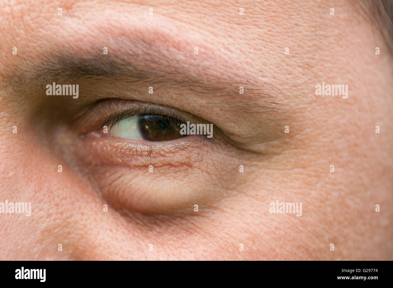 Obbrobrio, infiammazione o sacchetto gonfiore sotto l'occhio. Problema  medico come congiuntivite Foto stock - Alamy