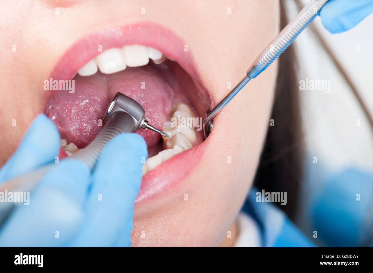 Close-up di trapano dentistico utilizzare per i denti del paziente in  odontoiatria ufficio in un trattamento dentale procedura Foto stock - Alamy