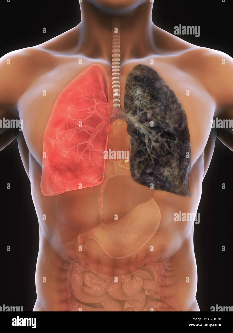 Polmone sano e il polmone per fumatori Foto Stock