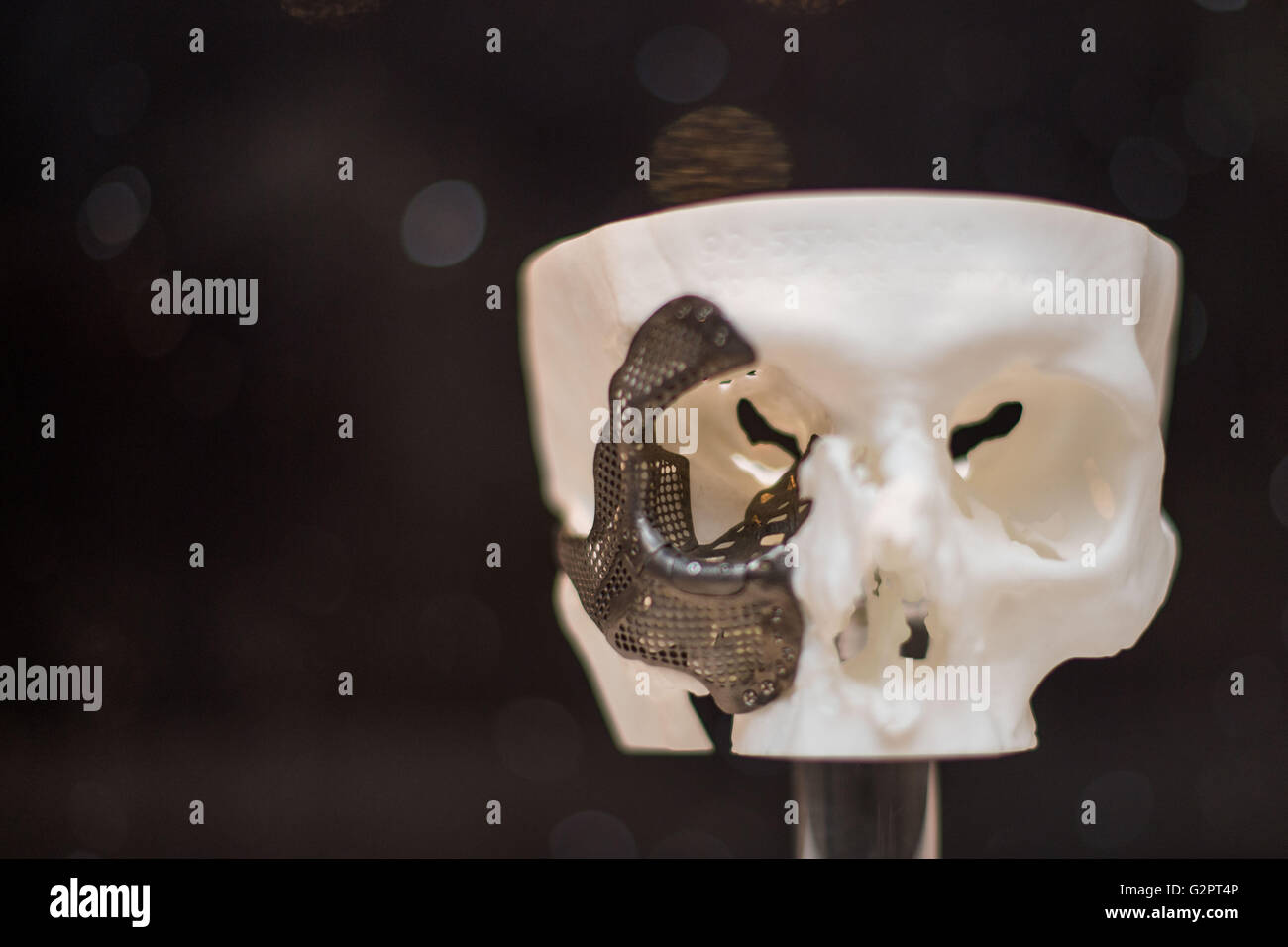 Amburgo, Germania. 02Giugno, 2016. La replica di un cranio con un impianto artificiale può essere visto nel corso di una conferenza stampa con la società tedesca per la somministrazione per via orale, la ganascia e la chirurgia del viso ad Amburgo, Germania, 02 giugno 2016. In futuro i chirurghi vuole ricostruire le facce di pazienti affetti da cancro e vittime di incidenti senza il trapianto di pelle e ossa. Foto: LUKAS SCHULZE/dpa/Alamy Live News Foto Stock