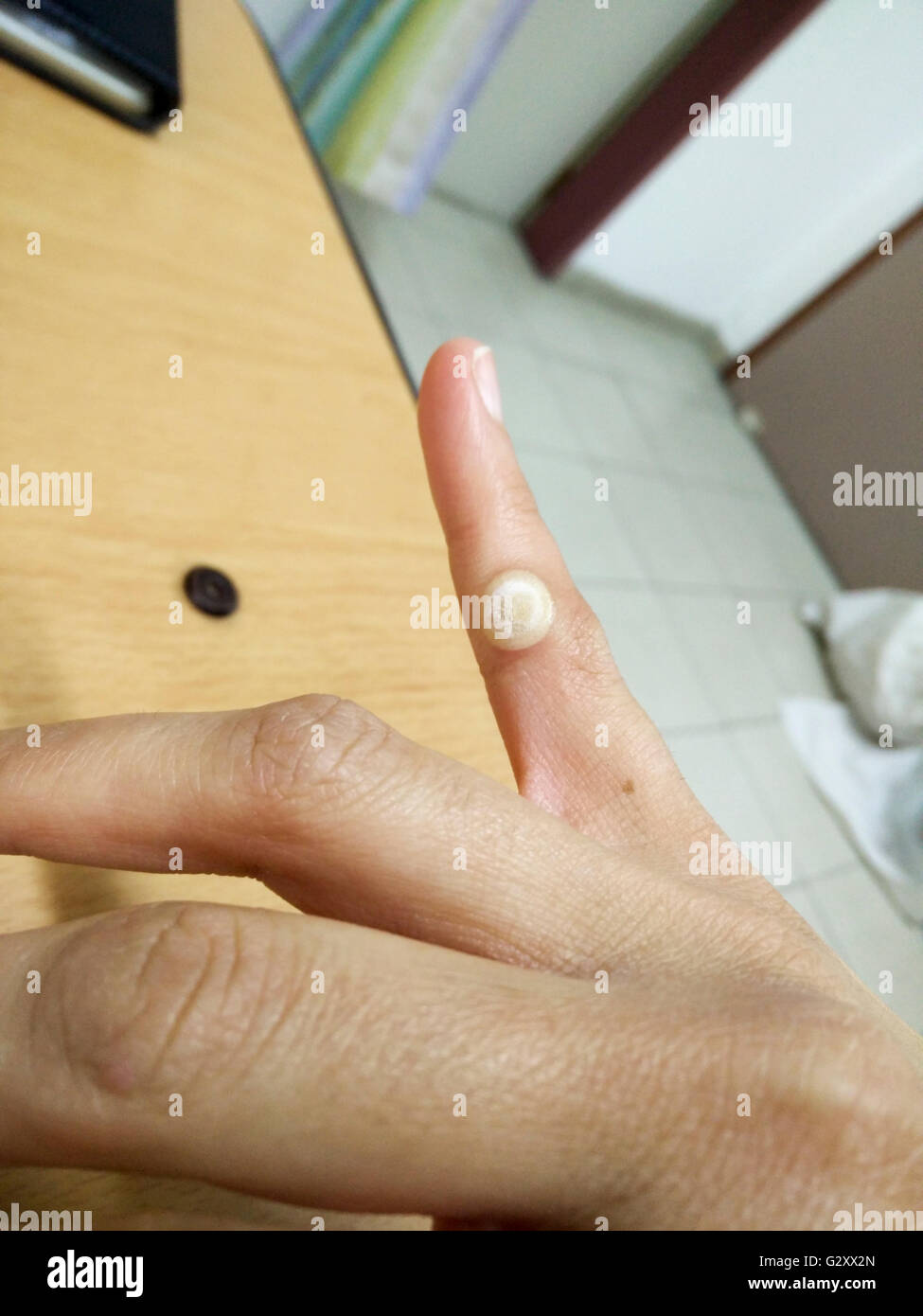 Close-up di una verruca sul dito indice di un paziente femmina. Le verruche sono innocui grumi sulla pelle causata dalla Human papilloma v Foto Stock