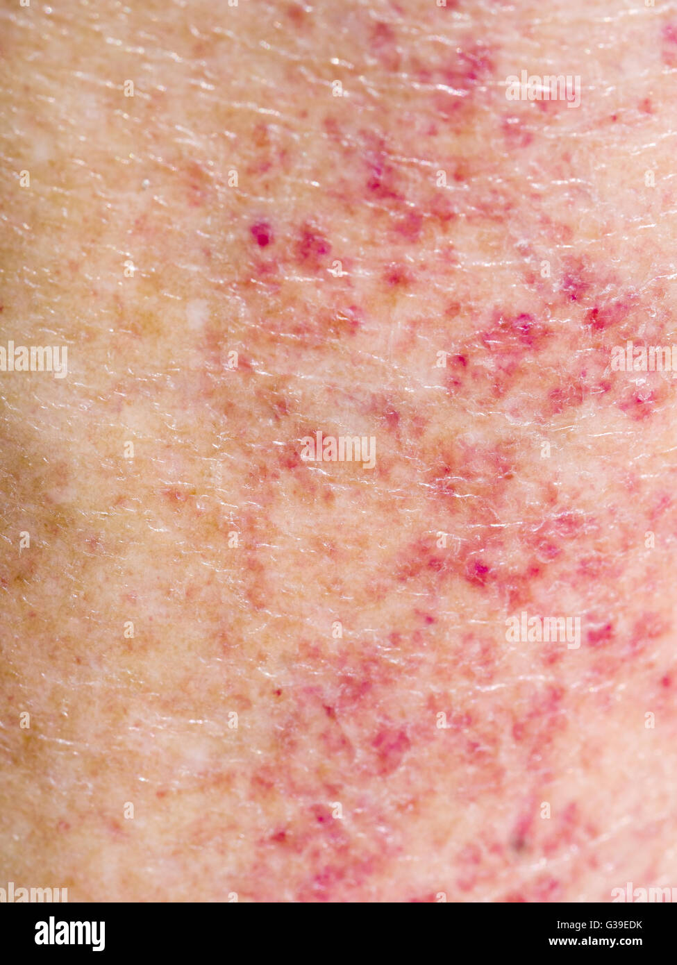 Eruzione cutanea rossa dalla combinazione di sole e farmaci. Allergia, sensibilità. Foto Stock