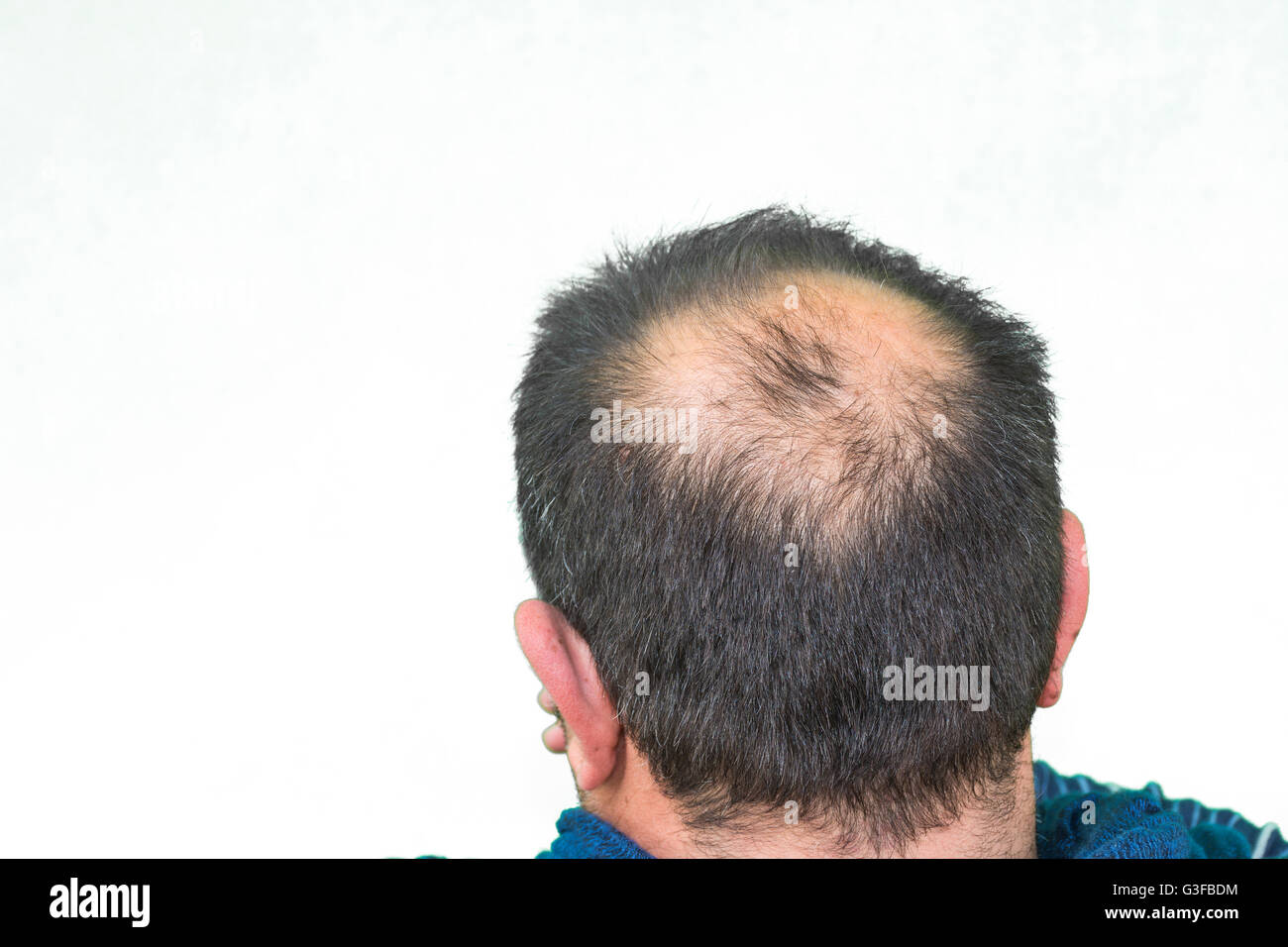 Maturo uomo yang, visto da dietro, nella testa, comincia a perdere i capelli, comincia ad essere vecchio. Foto Stock