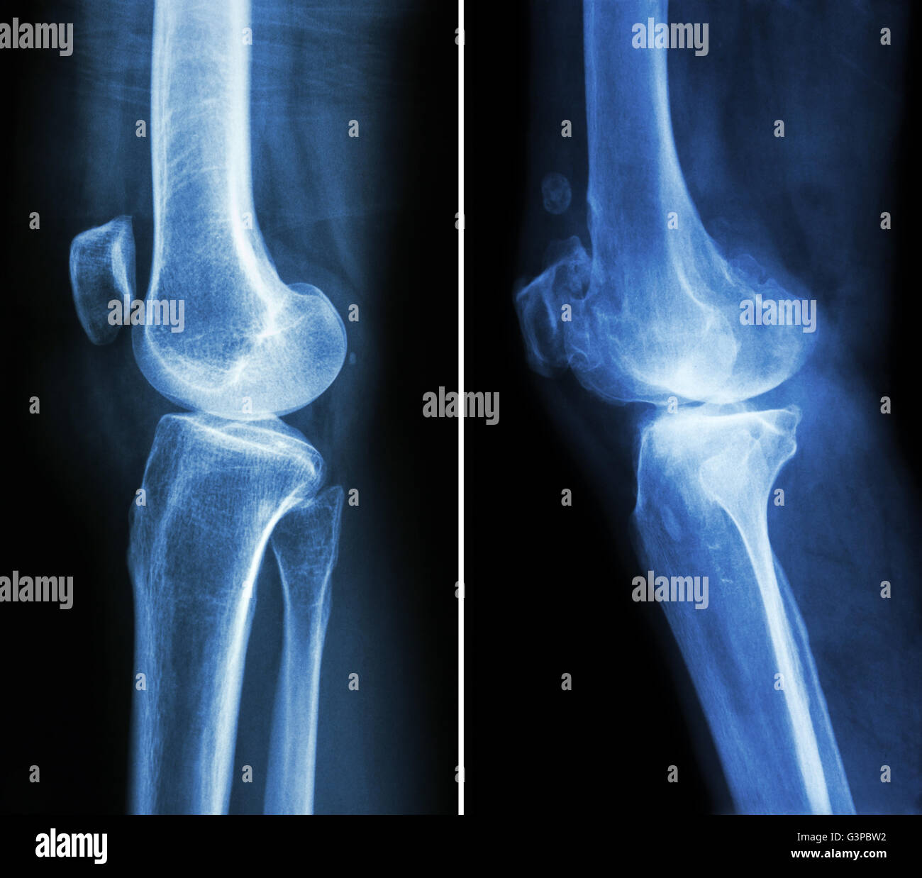 Ginocchio normale ( immagine a sinistra ) e osteoartrite del ginocchio destro ( immagine ) ( vista laterale ) Foto Stock