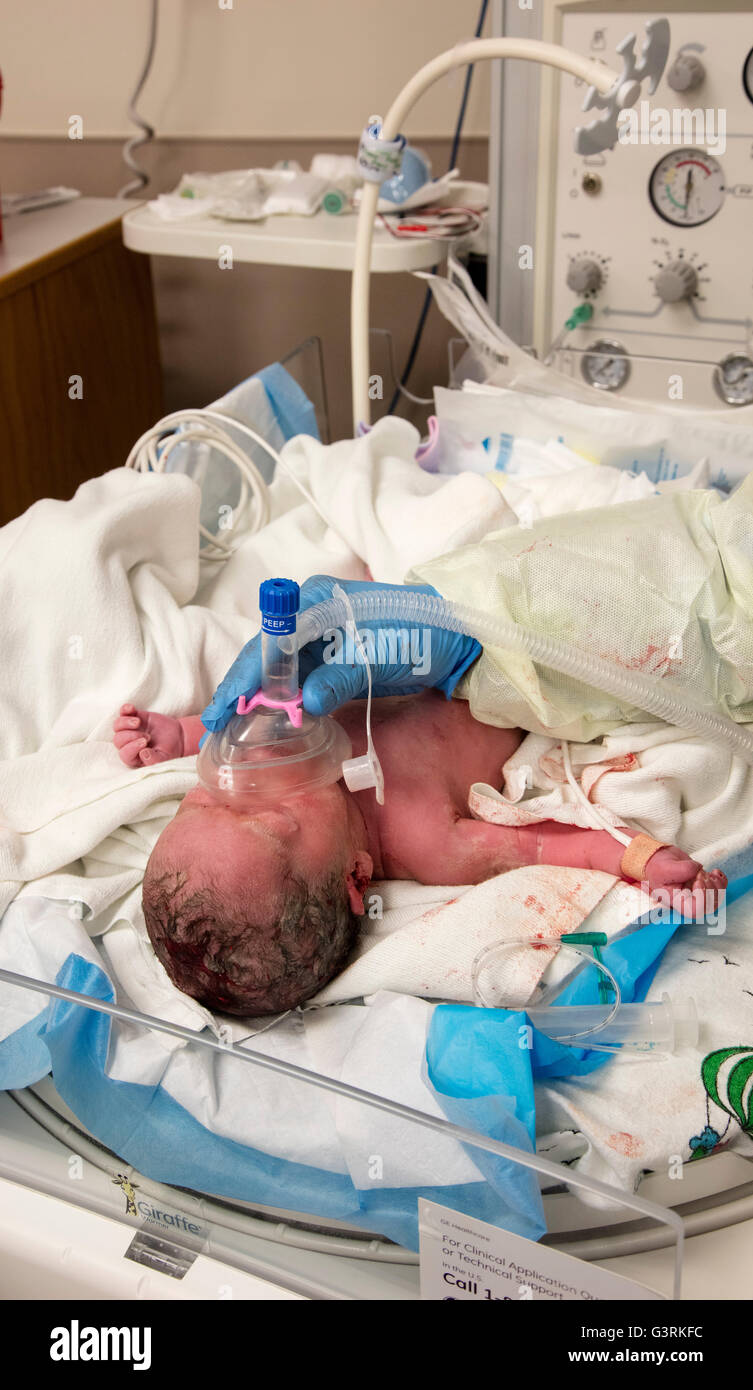 Cancellazione Airways nel nuovo bambino nato da taglio cesareo, Trio Kennewick Ospedale Generale di Tri-Cities, Washington, Stati Uniti d'America Foto Stock