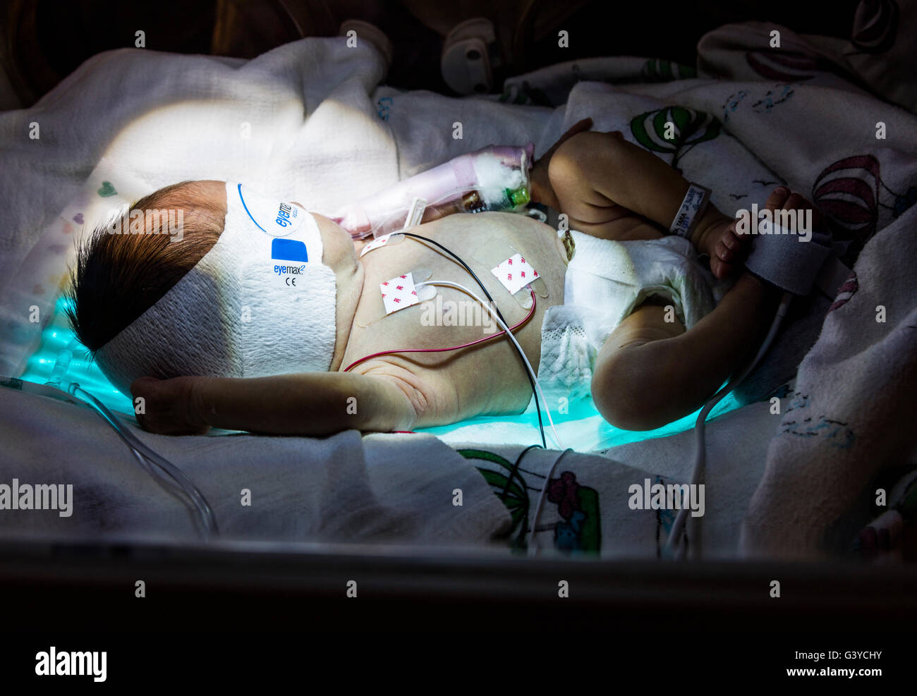 La fototerapia per elevati livelli di bilirubina in pre-termine new born baby, natal Intensive Care Unit (NICU), ospedale di maternità Foto Stock
