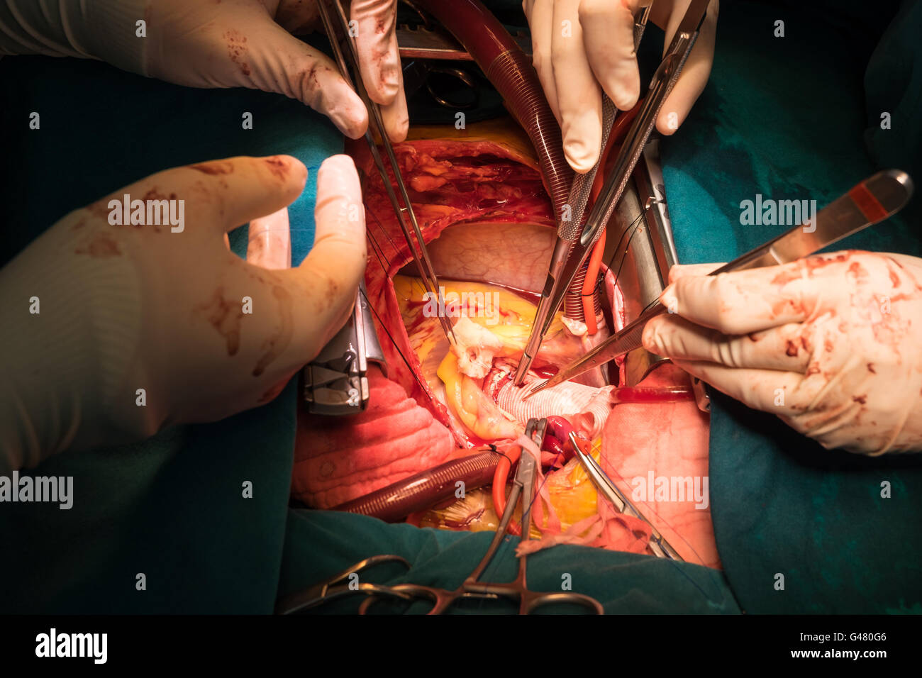 Bentall il funzionamento in ordine crescente di aneurisma aortico Foto Stock