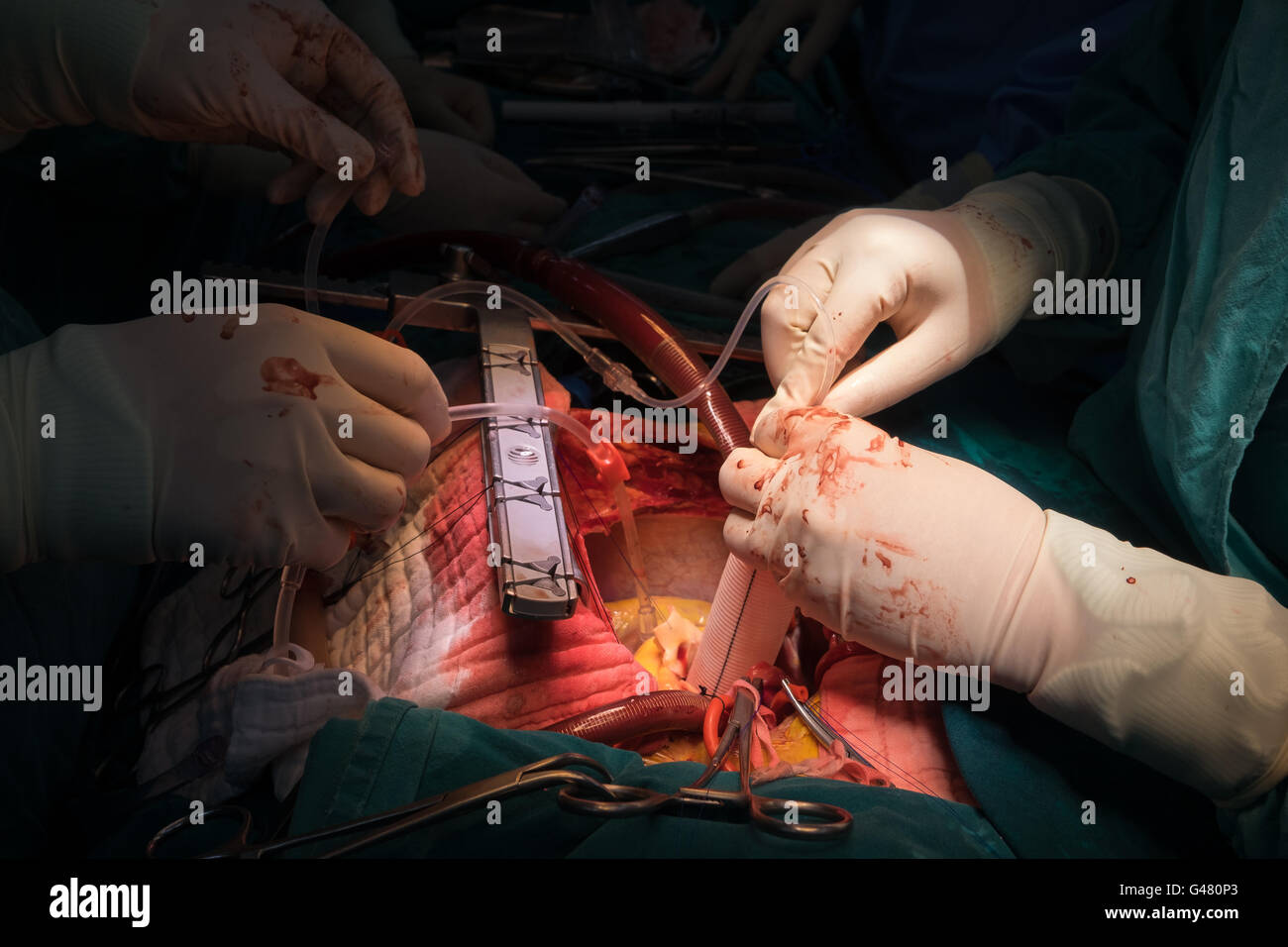 Bentall il funzionamento in ordine crescente di aneurisma aortico Foto Stock
