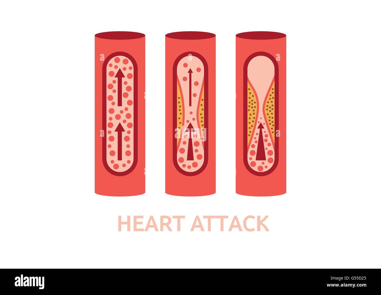 Attacco di cuore i sintomi delle arterie coronarie malattia sanità medicina illustrazione vettoriale Illustrazione Vettoriale