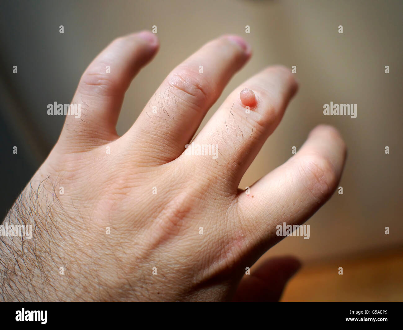 Verruca sul dito a mano. Foto Stock