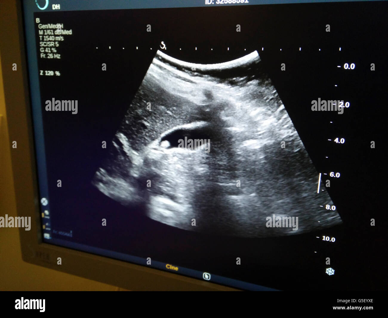 Ultrasuoni di una pietra della cistifellea di 12 anni, paziente di sesso femminile Foto Stock