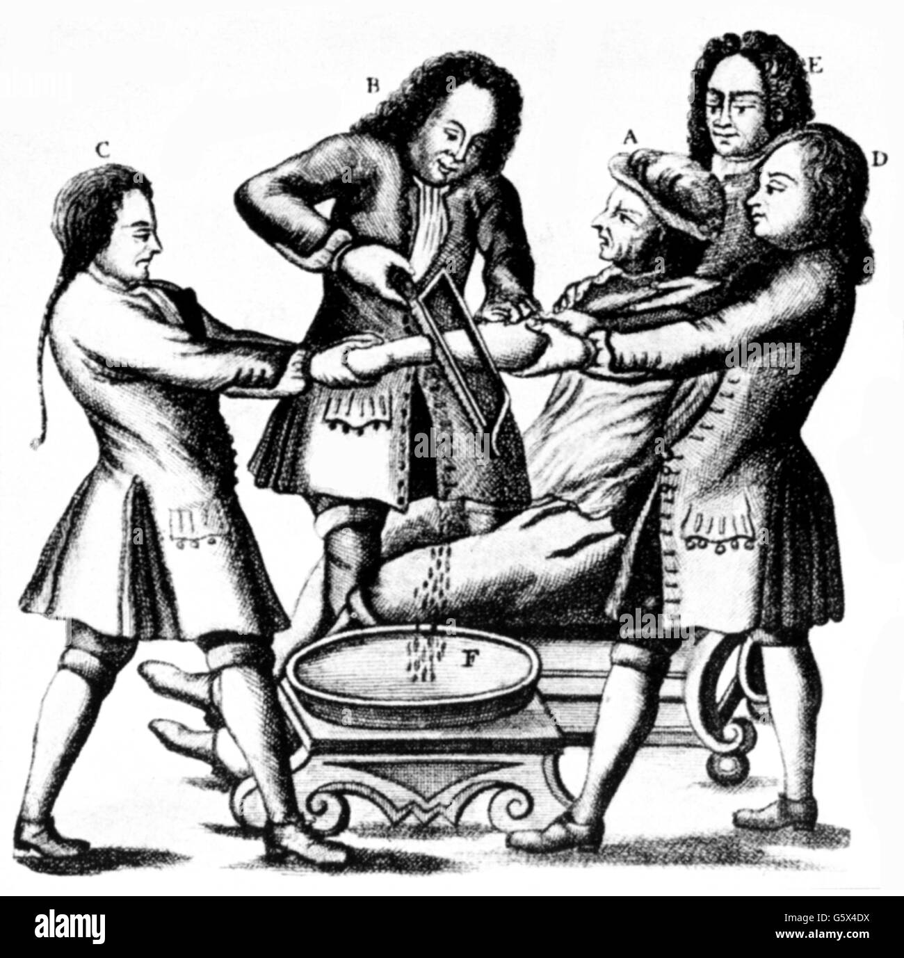 Medicina e Chirurgia, amputazione, amputazione del braccio con una sega d'osso, incisione su rame, fuori: Lorenz Heister (1683 - 1758), "Chirurgie', Norimberga, 1719, artista del diritto d'autore non deve essere cancellata Foto Stock