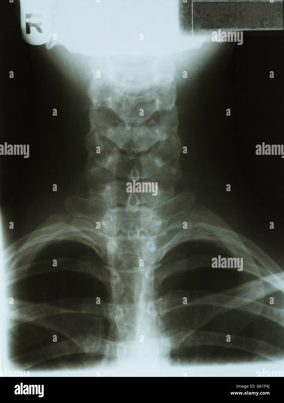 X Ray con il collo del torace e della testa. Foto Stock