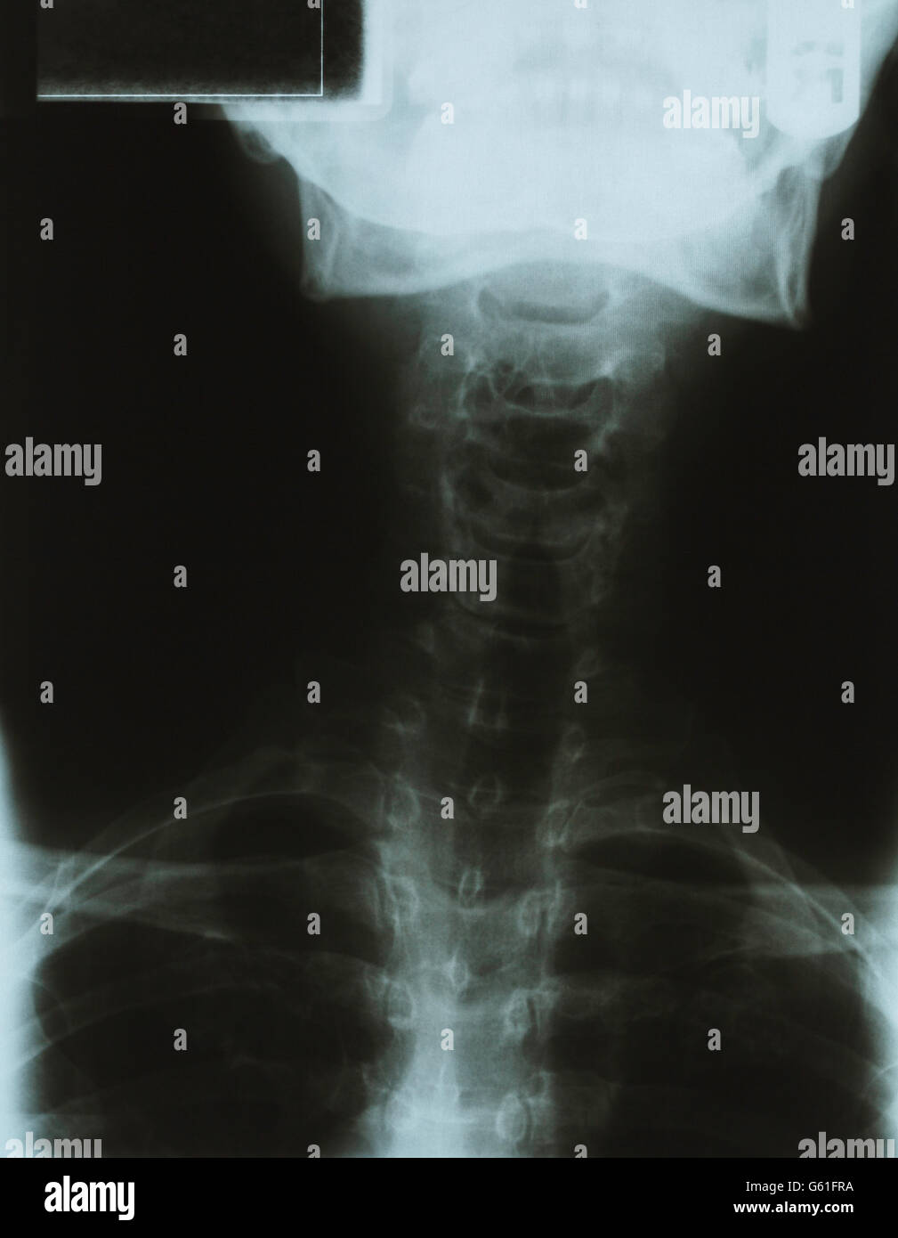 X Ray con il collo del torace e della testa. Foto Stock