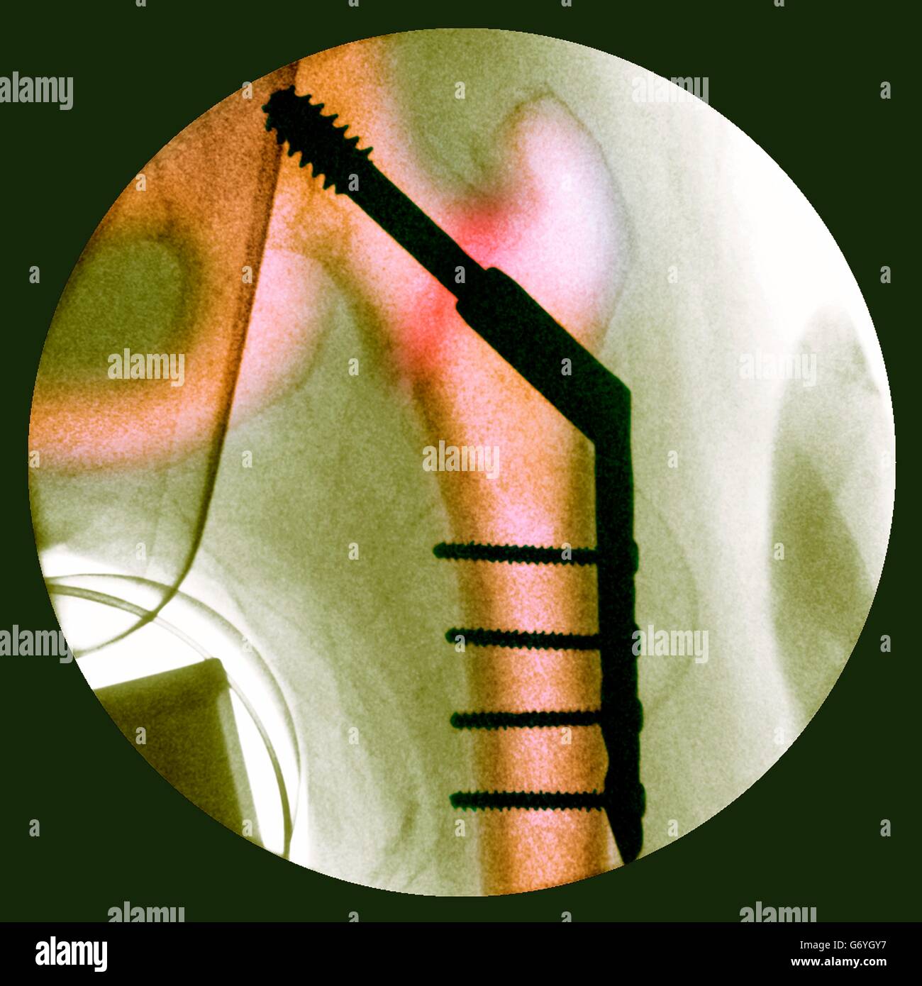 Appuntato anca fratturata. Colorato X-ray di una sezione attraverso l'anca di un 91-anno-vecchio paziente femmina con una frattura che colpiscono la testa del femore (thigh bone, verticale), che mostra le piastre e i perni (nero) essendo utilizzati per fissare l'osso rotto in sede durante l'hea Foto Stock