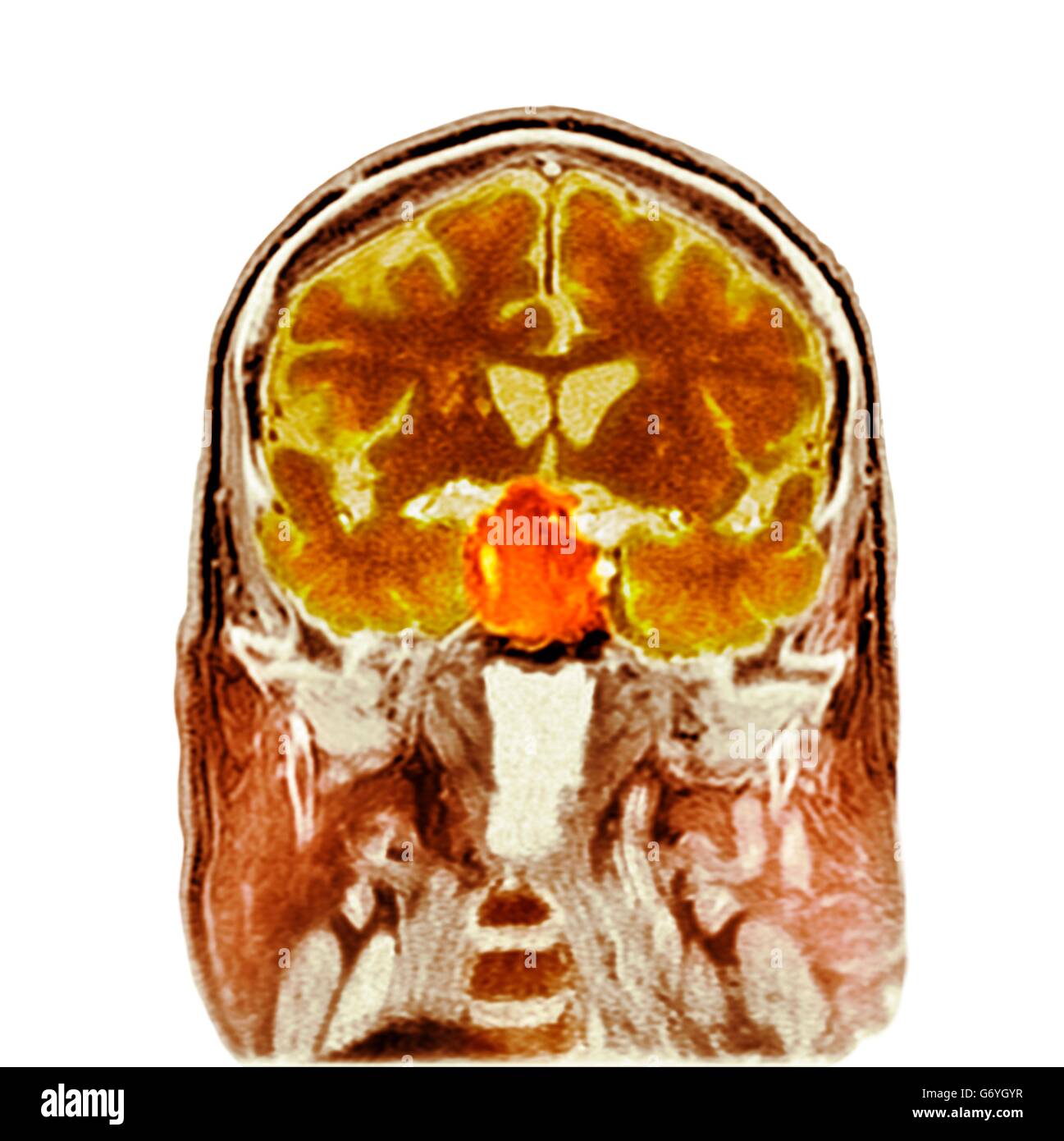 Tumore pituitario. Colorato la tomografia computerizzata (CT) scansione di una sezione attraverso il cervello di un 84-anno-vecchio paziente di sesso maschile con un tumore (rotondo, centro) che colpiscono la ghiandola pituitaria. La ghiandola pituitaria tumori sono solitamente adenomi - benigno (non cancerosi) ari Foto Stock