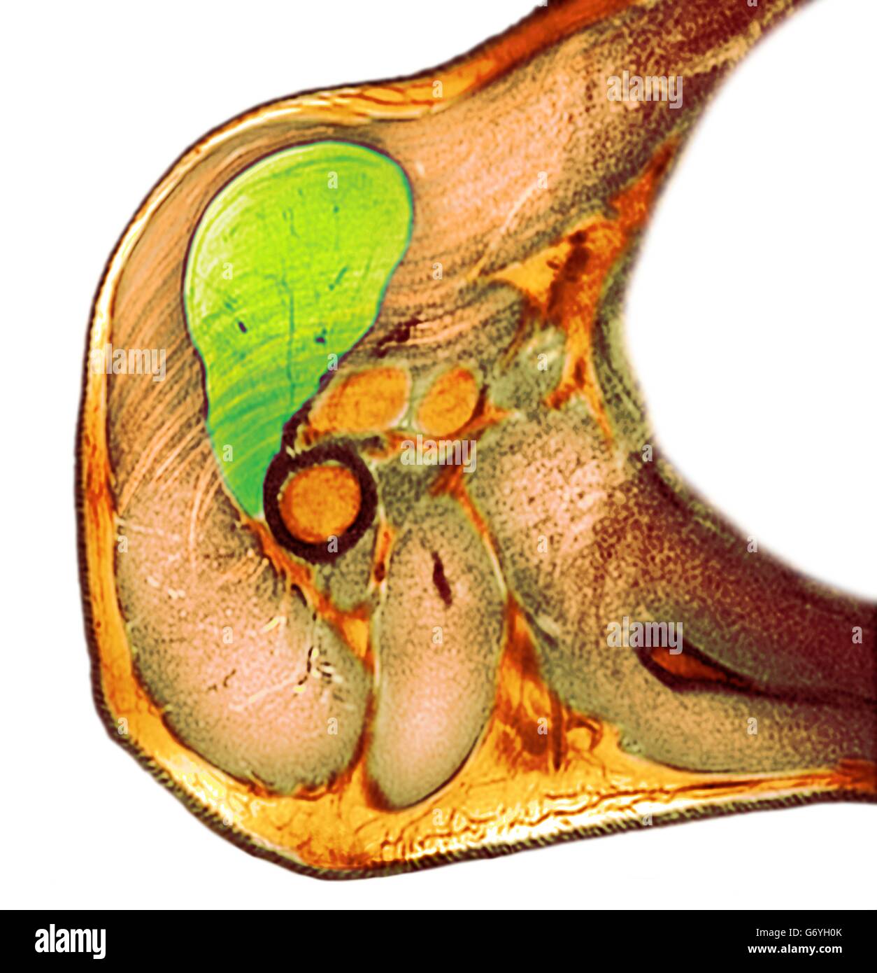 Lipoma della spalla. Colorato X-ray della spalla di un 58-anno-vecchio paziente di sesso maschile che mostra una grande lipoma. Lipomas sono benigni (non cancerosi) derivanti da tessuto adiposo (FAT) tessuto. Essi sono la forma più comune di un tessuto morbido del tumore. Foto Stock