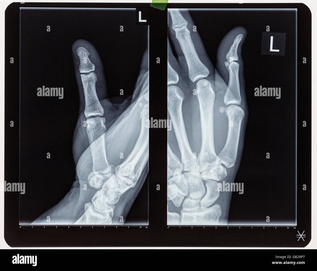 Immagine a raggi X della mano umana Foto Stock