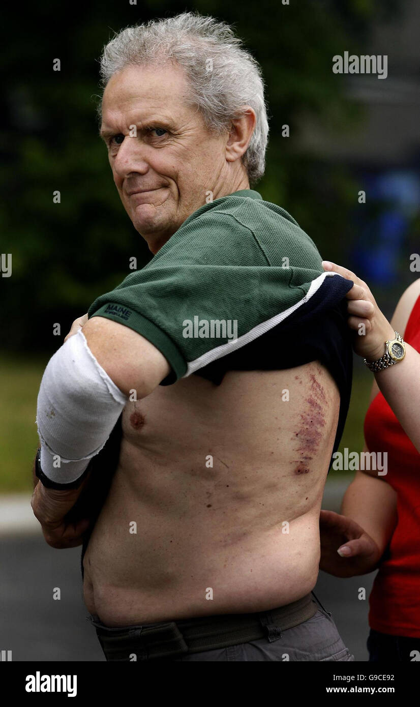 Peter Broadbent mostra le sue piaghe dopo una conferenza stampa a Ashton-under-Lyme stazione di polizia in Manchester. Foto Stock