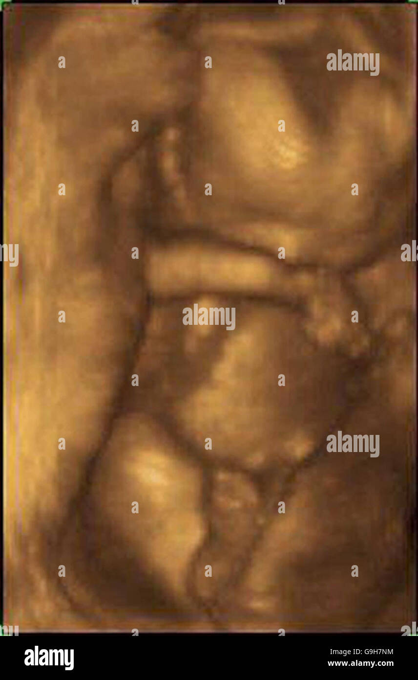 File della libreria, precedentemente rilasciato il 29/06/2004. Un bambino di 12 settimane ha catturato succhiando il pollice, in un'immagine scattata utilizzando un sofisticato sistema a ultrasuoni. Foto Stock