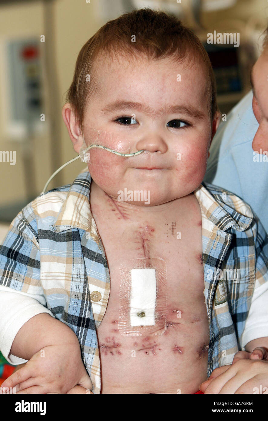 Jack Vellam, 13 mesi, che è diventato il primo bambino al mondo a sopravvivere per 120 giorni su un cuore artificiale esterno. Foto Stock