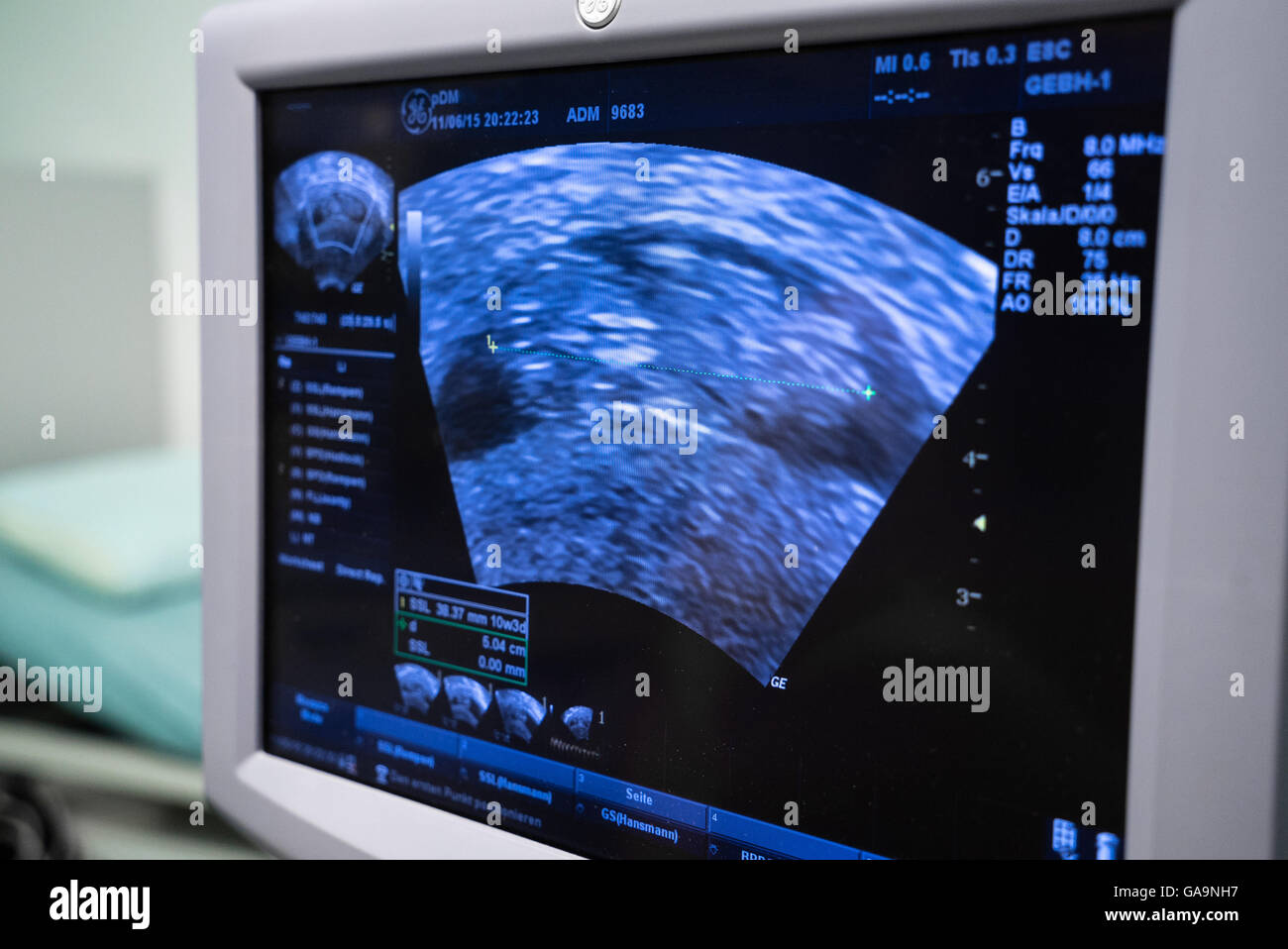 Gravidanza ad ultrasuoni immagine di scansione Foto Stock