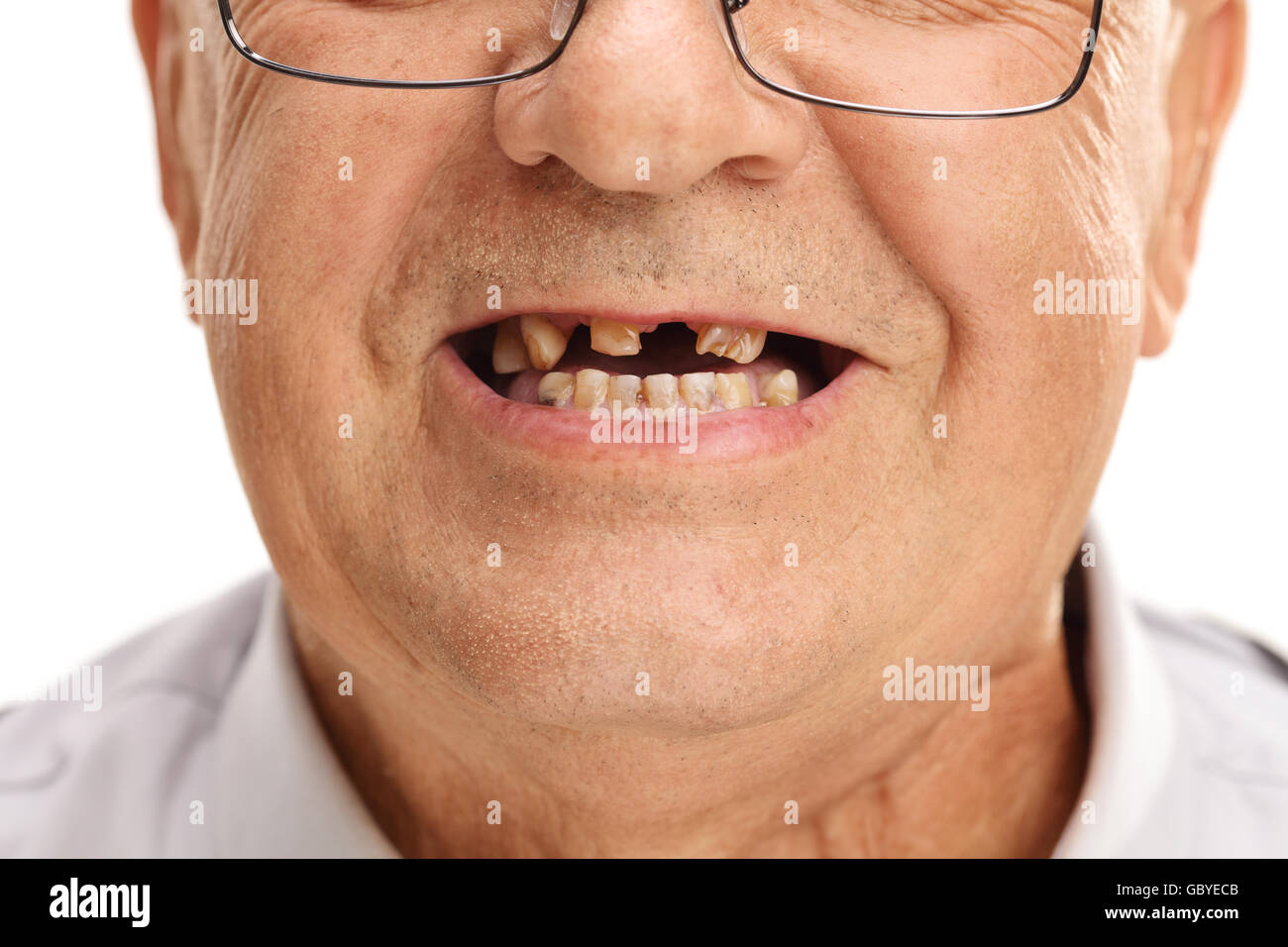 Close-up studio shot sulla bocca di un uomo anziano con un paio di denti rotti isolati su sfondo bianco Foto Stock