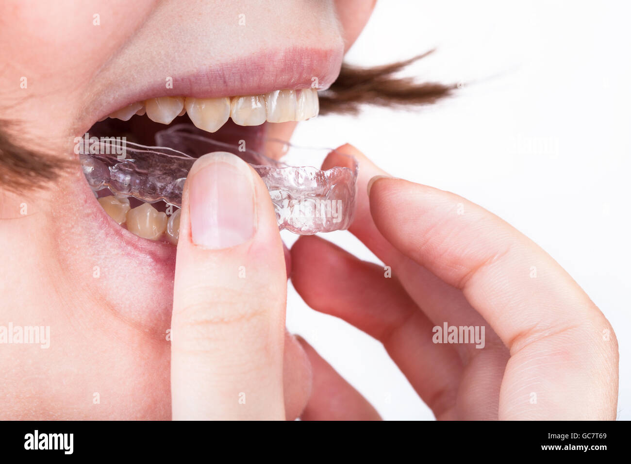 Giovane donna mette in chiaro per allineatore di correzione ortodontica di morso Foto Stock