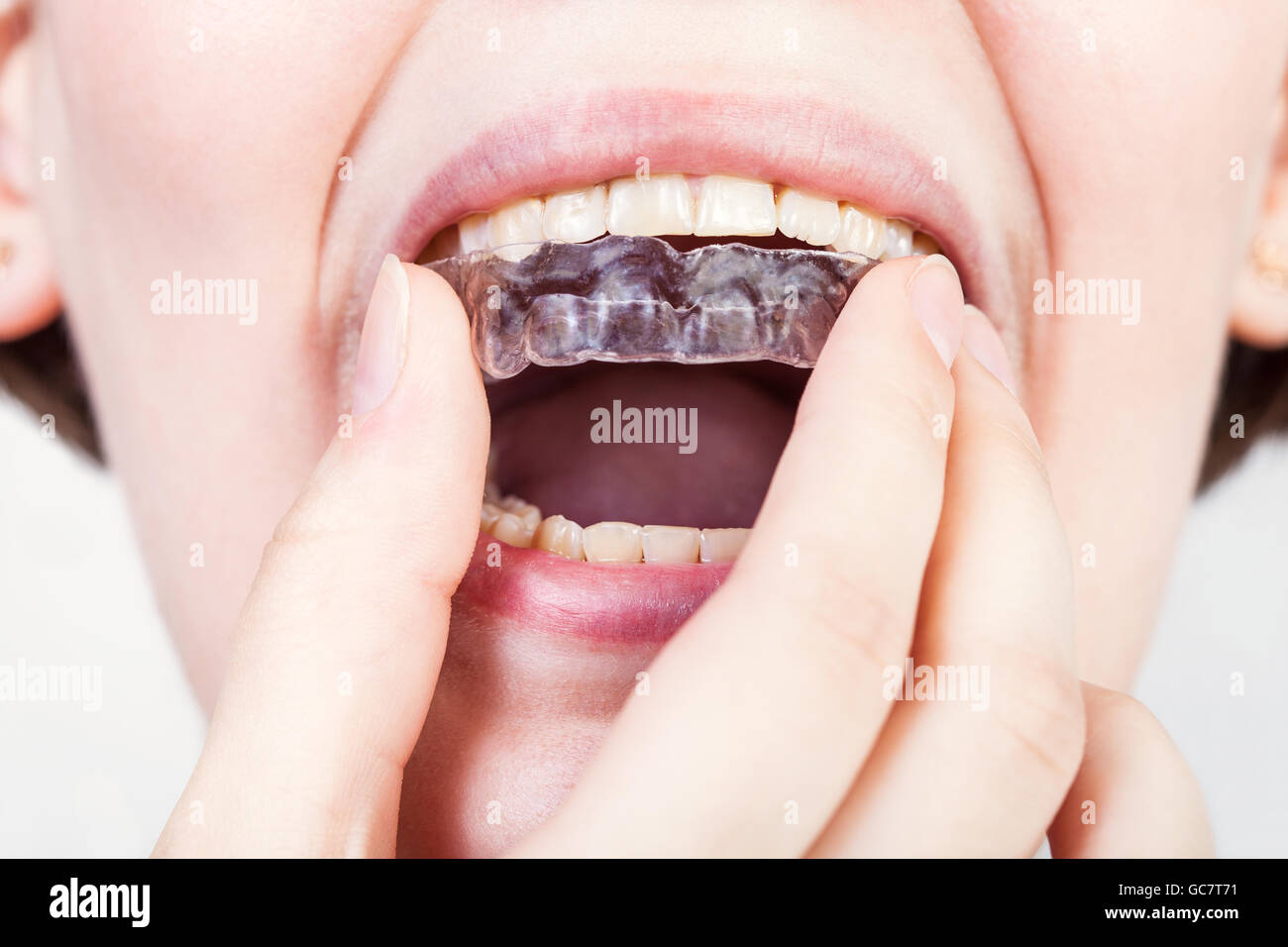 Vista diretta della giovane donna di fissaggio allineatore di chiara per la correzione ortodontica di morso Foto Stock