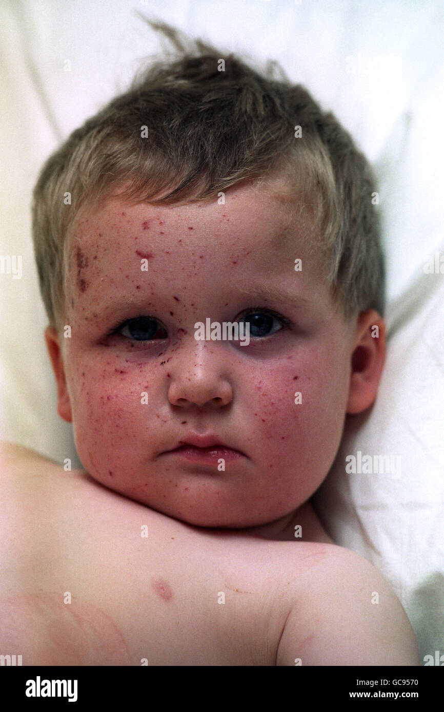 DUE ANNI STEPHEN WOOLLEY IN OSPEDALE A BELFAST DOPO ESSERE STATO SOTTOPOSTO A ULTERIORE INTERVENTO CHIRURGICO PER LE LESIONI RICEVUTE NELL'OLTRAGGIO DELLA BOMBA SHANKILL. Foto Stock