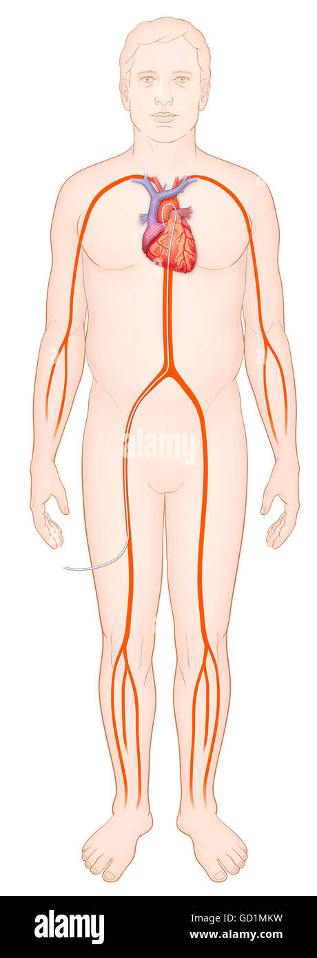 Schema di un uomo e di sistema arterioso con un catetere attraverso l'arteria femorale al cuore Foto Stock